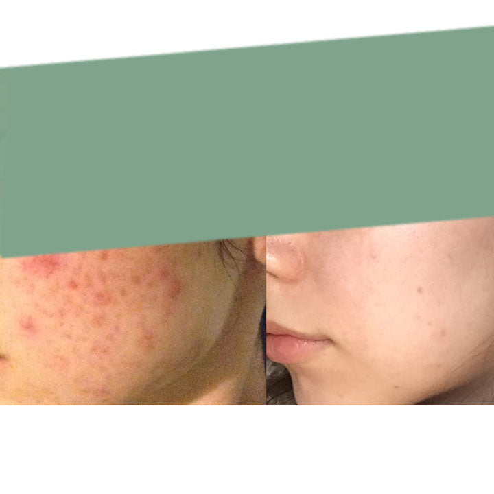 Acne Spot Treatment (All Skin Types)